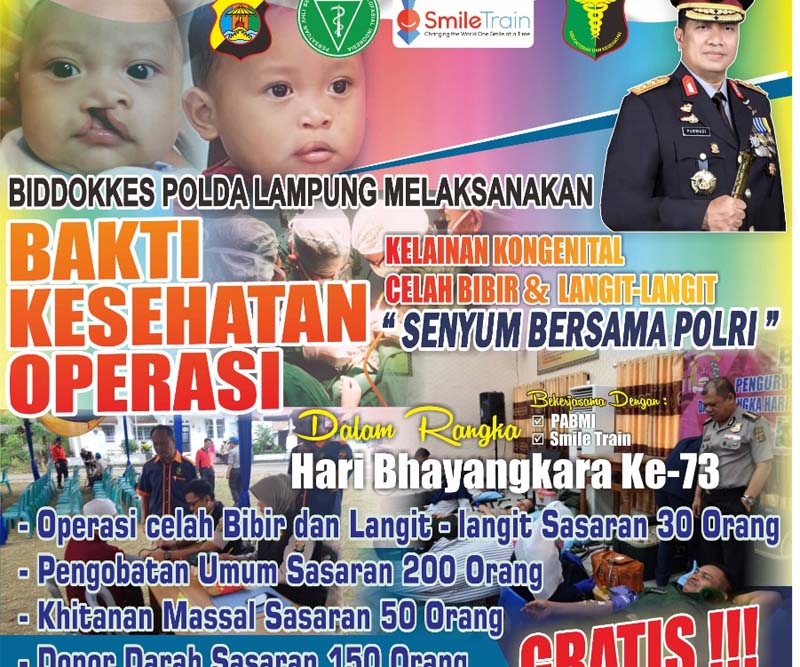 Operasi Celah Bibir dan Langit-Langit Polda Digelar 18 Juni 2019, Ini Syaratnya Jika Ingin Mendaftar