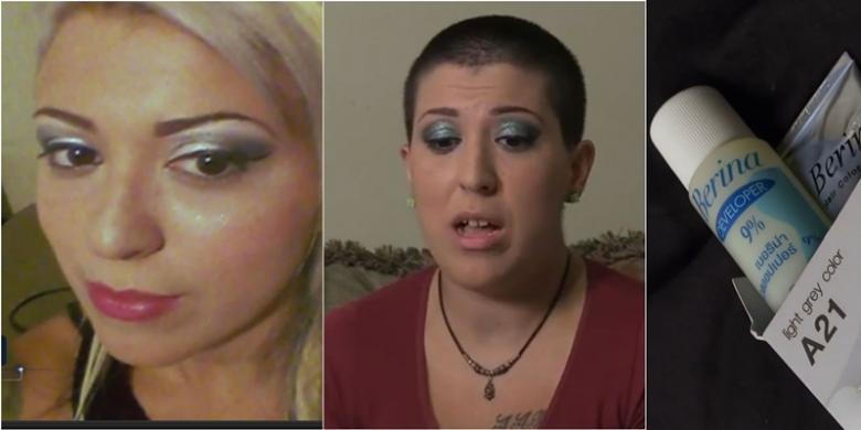 Rambut Wanita Ini Rontok Hingga Botak Usai Diwarnai