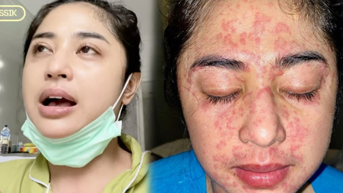 Positif Covid-19, Wajah Dewi Perssik Timbul Bercak-Bercak Kemerahan