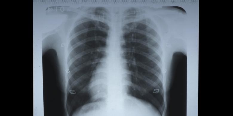 Biaya Rontgen Tidak Ditanggung BPJS?