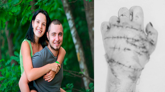 Sadis! Dibakar Cemburu, Pria Ini Nekat Potong Kedua Tangan Istrinya, Begini Kondisinya