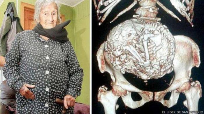 Didiagnosa Tumor, Nenek 90 Tahun Ternyata Hamil dengan Kandungan Berusia 60 Tahun!