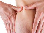 halo-dokter-apa-itu-stretch-mark-dan-cara-menghilangkannya.jpg