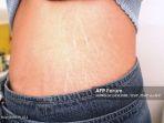 halo-dokter-penjelasan-apa-itu-stretch-mark.jpg