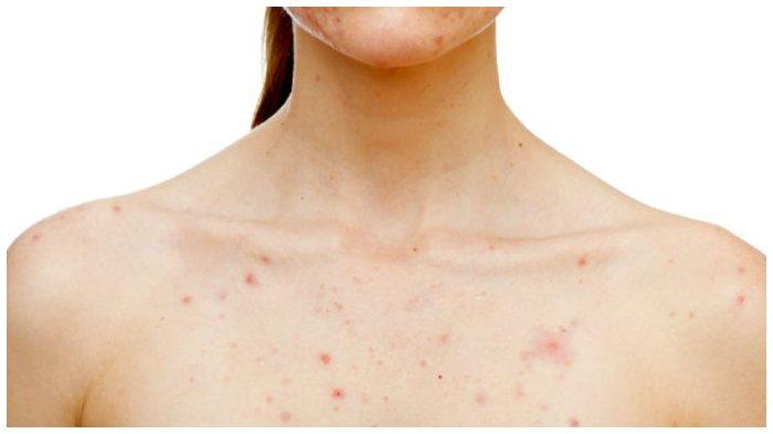 Obat Alami untuk Mengobati Jerawat Dada, Simak Cara Membuatnya Berikut Ini