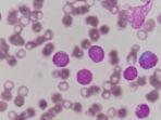 ilustrasi-sel-darah-pada-leukemia-tipe-aml.jpg