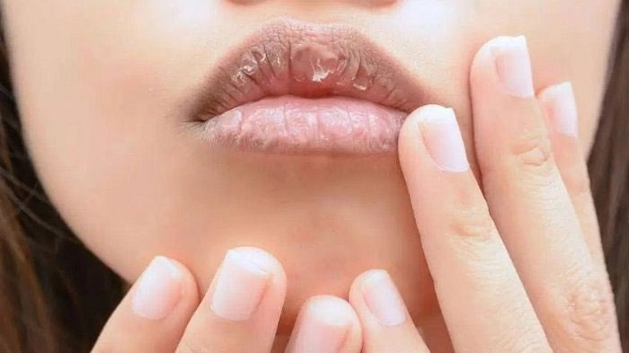 Bibir Kering dan Pecah-Pecah Bikin Penampilan Mengganggu, Gunakan 5 Cara Mudah Berikut ini