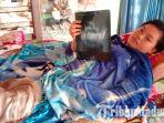 anggun-juwita-sari-siswi-sman-1-pademawu-pamekasan-tunjukkan-hasil-foto-rontgen-patah-tulang.jpg