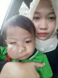 Bayi Asal Bone Derita Tumor Rahang Butuh Uluran Tangan Anda