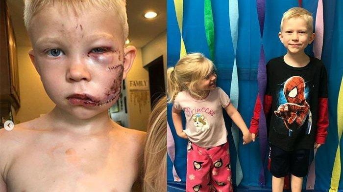 Viral Aksi Heroik Penyelamatan Gadis Kecil oleh Kakaknya Bertarung dengan Anjing, Wajah Robek
