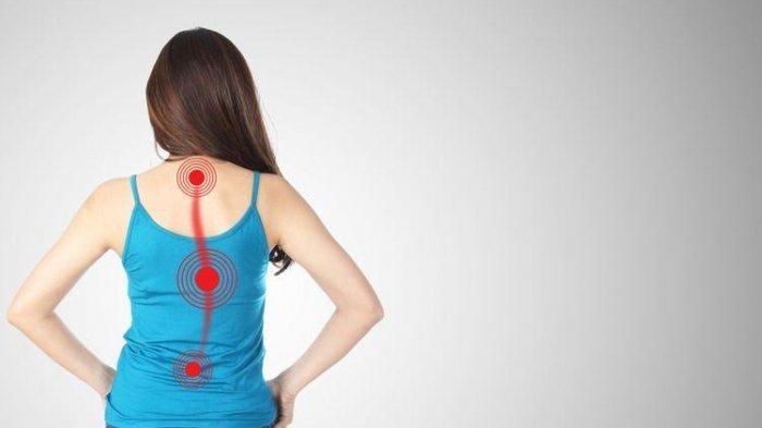 Mengenal Skoliosis, Gangguan Tulang Belakang yang Melengkung, Diidap Artis Jessica Mila Sejak SMP