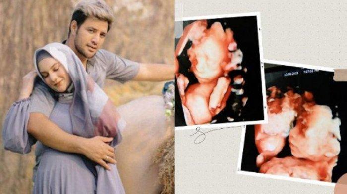 ALHAMDULILLAH! Irish Bella Melahirkan dengan Selamat Bayi Laki-laki, Mirip Ammar Zoni?