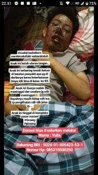 Pemuda Marawi Pinrang Ini Derita Penyakit Kulit Aneh, Butuh Uluran Tangan