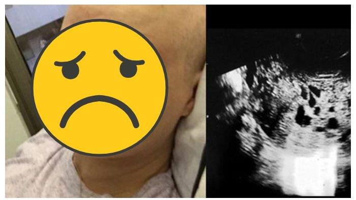 Awalnya Gembira Perut Buncit Dikira Hamil, Belakangan Ketahuan Ada Hal Ngeri di Organ Dalamnya