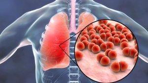Ilustrasi-peradangan-Paru-paru-yang-terserang-pneumonia.jpg
