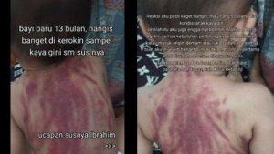Penampakan-punggung-bayi-13-bulan-dikerok-pengasuh-k.jpg