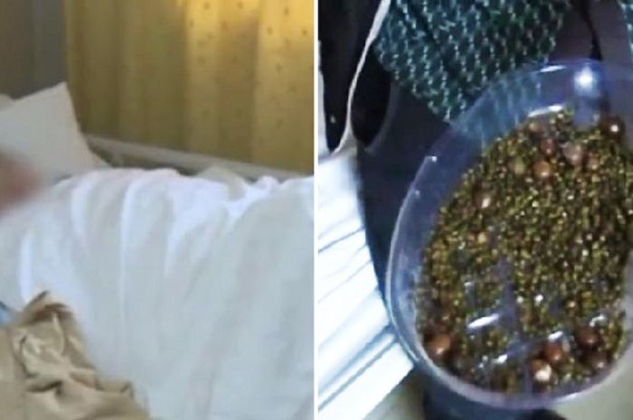 Gara-gara Jarang Sarapan, Dokter Temukan 2.000 Batu Empedu dalam Tubuh Wanita Ini