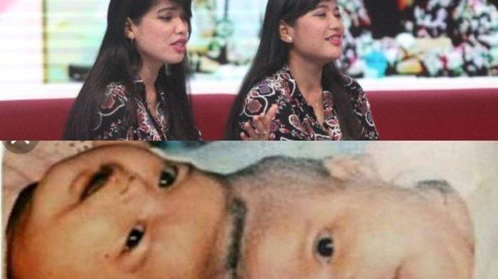 Ingat-Yuliana-dan-Yuliani-Bayi-Kembar-Siam-Pertama-di-Indonesia-Berhasil-Dioperasi-Kabarnya-Kini.jpg