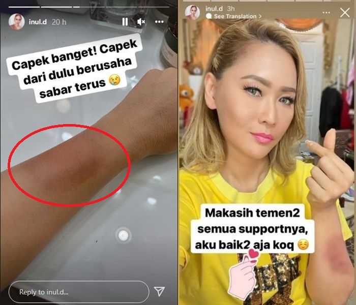 penyebab-tangan-inul-daratista-lebam-akhirnya-terungkap-istri-adam-suseno-minta-maaf-maafin-inul.jpg