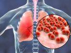 Ilustrasi-peradangan-Paru-paru-yang-terserang-pneumonia.jpg