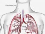 mengenal-pneumonia-diidap-pasien-isolasi-yang-meninggal-di-rspi-sulianti-saroso.jpg