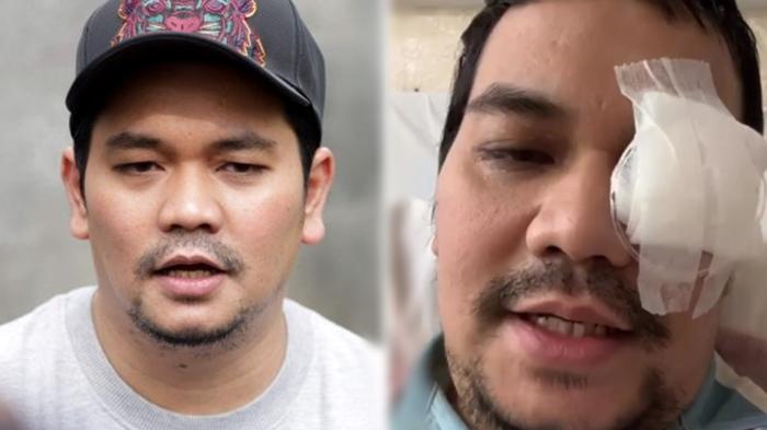 Kondisi-Indra-Bekti-Setelah-Operasi-Mata-Diungkap-Indy-Barends-Tuai-Doa.jpg