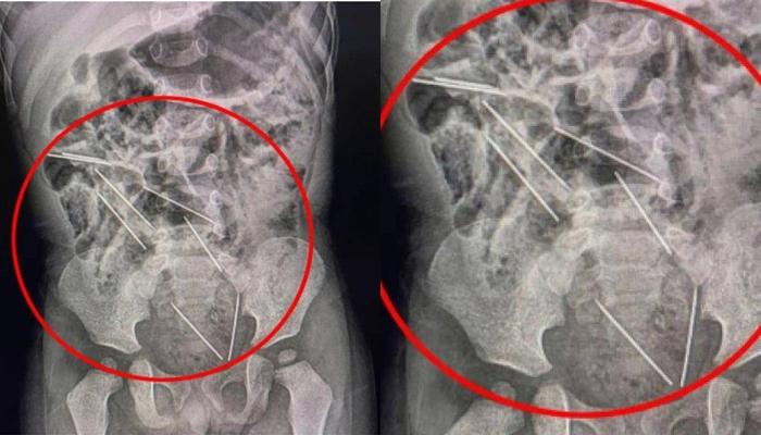 Pantas-Dokter-Syok-Lihat-Hasil-Rontgen-Bayi-2-Tahun-ini-Ternyata-Ditemukan-8-Jarum-di-Perutnya.jpg