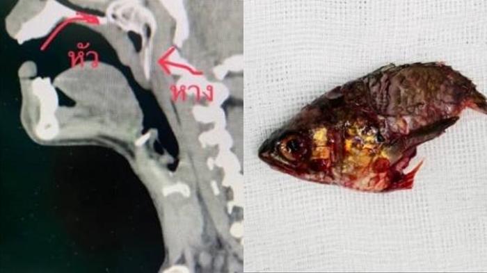 Ikan Lompat Masuk Mulut, Seorang Nelayan Nyaris Tewas saat Ikan Menggeliat Terjebak di Tenggorokan