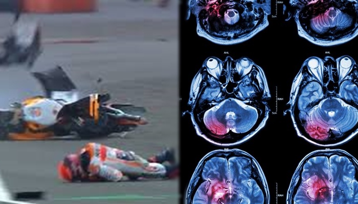 apa-itu-gegar-otak-cedera-dialami-marc-marquez-akibat-terjatuh-di-motogp-mandalika-ini-bahayanya.jpg