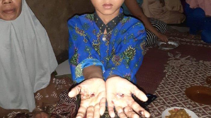 Cacar Monyet Dikabarkan Serang Anak-anak Satu Desa, Kenali Ciri dan Gejalanya