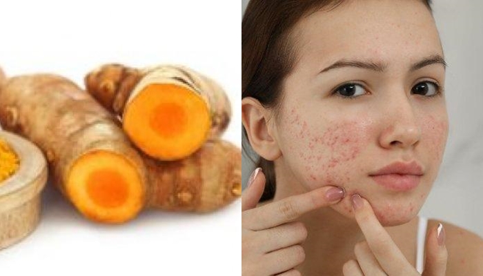 Tak Banyak yang Tahu, Cara Ampuh Mengobati Jerawat dengan Kunyit