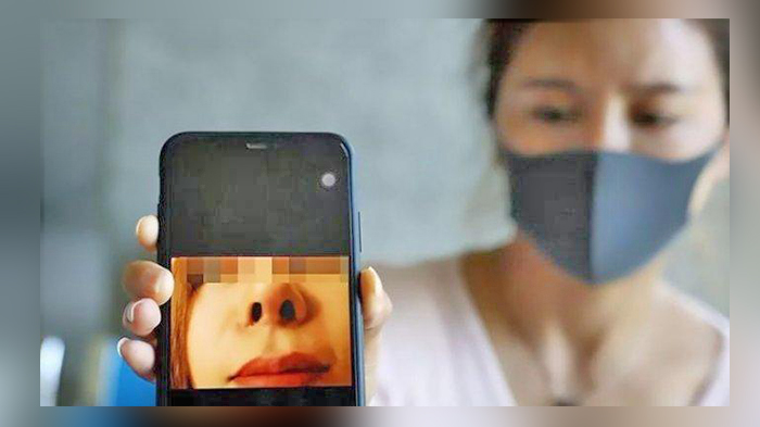 Operasi Plastik Untuk Kecantikan, Keluarkan Uang Ratusan Juta, Hasilnya Ada Lubang Yang Tak Sesuai