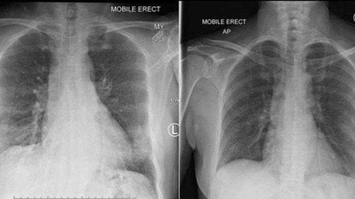 hasil-rontgen-memperlihatkan-paru-paru-pasien-bersih-2342.jpg