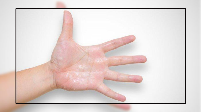 PENYEBAB Keringat Dingin Ada 9, Waspada Penyakit Serius Yang Bisa Mengakibatkan Kematian