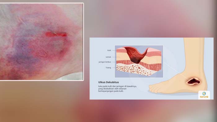 kenali-penyakit-dekubitus-2347378.jpg