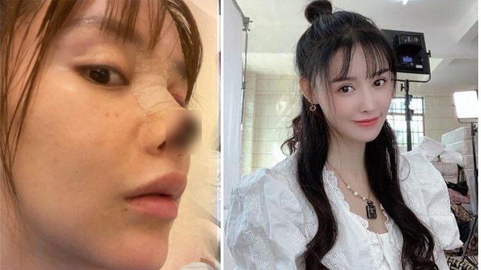 Operasi Hidung Agar Mancung Malah Menghitam, Aktris Cantik Ini Kehilangan Job dan Nyaris Bunuh Diri