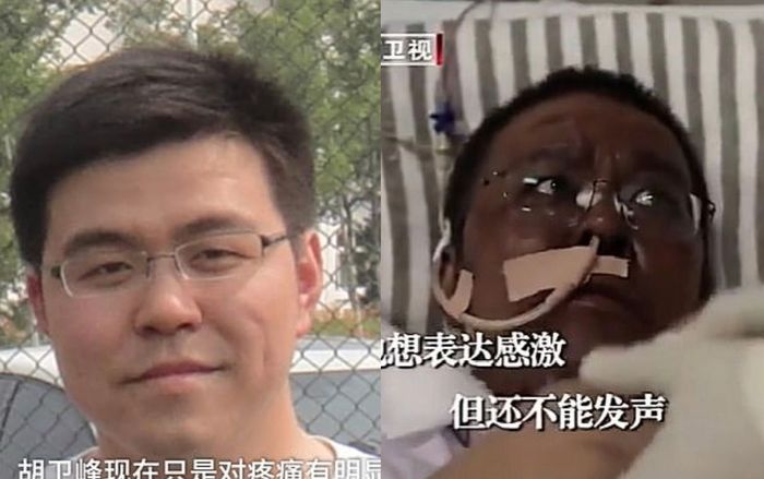 kulit-dokter-hu-weifeng-juga-berubah-menjadi-hitam-setelah-perawatan-corona.jpg