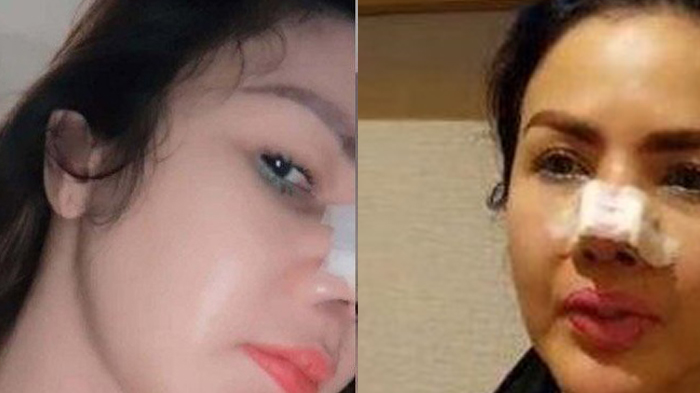 nasib-artis-yang-dulu-oplas-miliaran-bikin-ibu-melarat-kini-hidung-bernanah.jpg