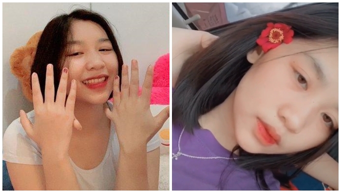 pengalaman-gadis-bernama-vio-yang-mengidap-polidaktili-sejak-lahir.jpg