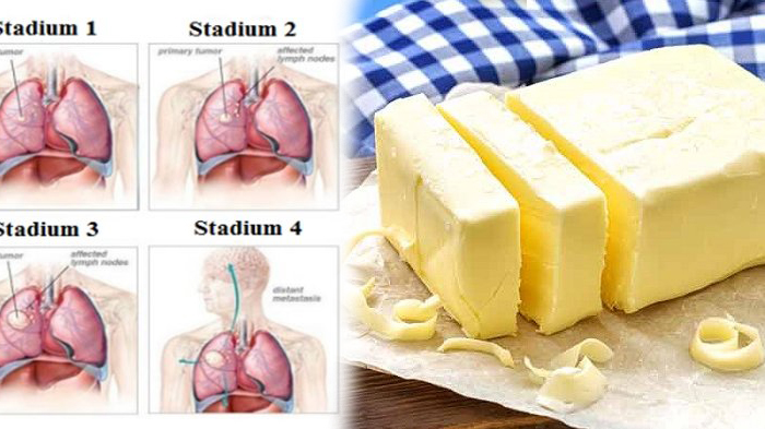 Hati-Hati, Mungkin Anda Sudah Rutin Konsumsi Makanan Pemicu Kanker, Simak Ini