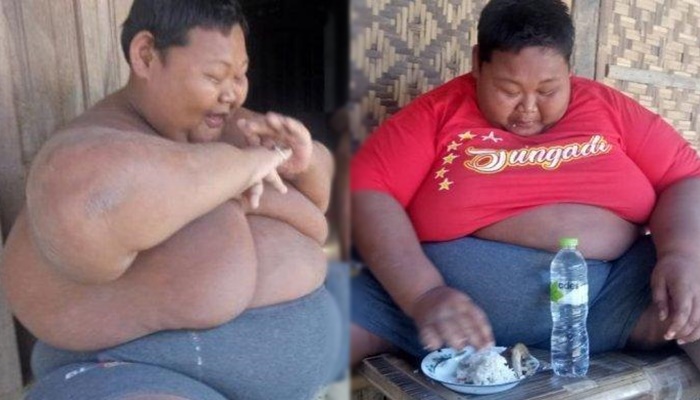 sungadi-alami-obesitas-hingga-bobotnya-140-kilogram.jpg
