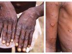6-fakta-virus-monkeypox-penyakit-cacar-monyet-yang-pertama-kali-muncul-di-singapura.jpg