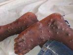 Kondisi-kaki-yang-terserang-virus-cacar-monyet-atau-monkeypox.jpg