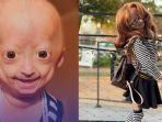 adalia-rose-8-tahun-lalu-viral-wajahnya-bak-nenek-nenek-sdfsdfg.jpg