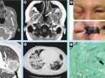 apa-itu-mucormycosis-serang-pasien-covid-19-di-india-bisa-terhirup-atau-masuk-melalui-luka.jpg