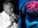 apa-itu-pendarahan-otak-yang-dialami-tukul-arwana-ini-penyebab-dan-gejala-yang-harus-diwaspadai.jpg