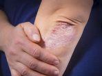 apa-itu-psoriasis-penyakit-kulit.jpg