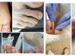 gejala-baru-virus-corona-kembali-ditemukan-lesi-keunguan-di-kaki1.jpg