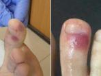 gejala-baru-virus-corona-ruam-kaki-jari-kaki-berwarna-biru-keungu-unguan.jpg