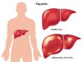 hepatitis-ist.jpg